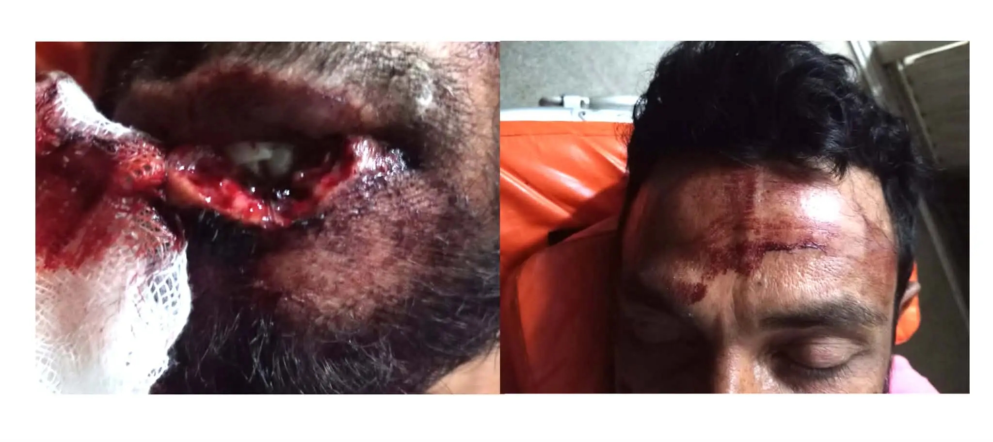 শান্তিগঞ্জে নিরীহ যুবকের ঠুট কেটে নিল প্রতিপক্ষ
